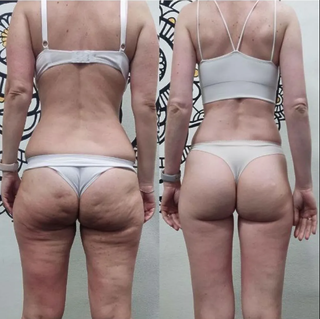 Лімфодренажний масаж