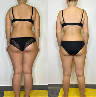 Лімфодренажний масаж