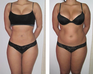 Лімфодренажний масаж