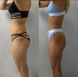 Лімфодренажний масаж